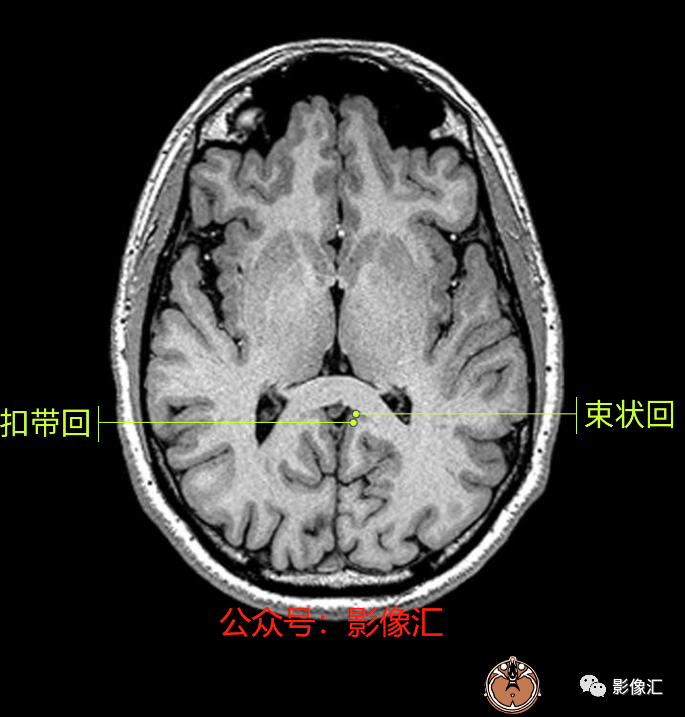 影像PPT - 脑边缘叶MR解剖标记-36