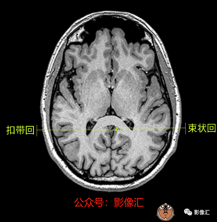 影像PPT - 脑边缘叶MR解剖标记-37