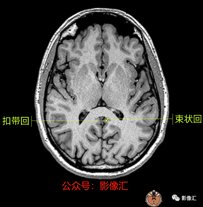 影像PPT - 脑边缘叶MR解剖标记-38
