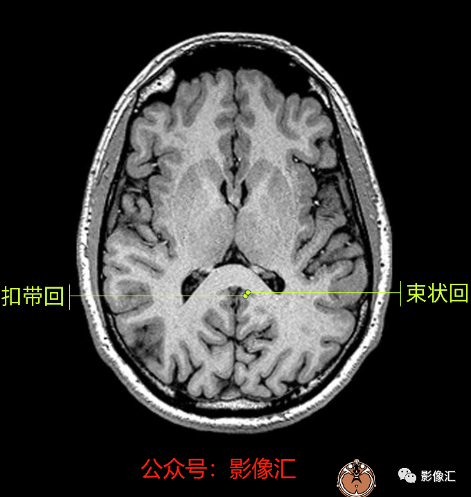 影像PPT - 脑边缘叶MR解剖标记-39