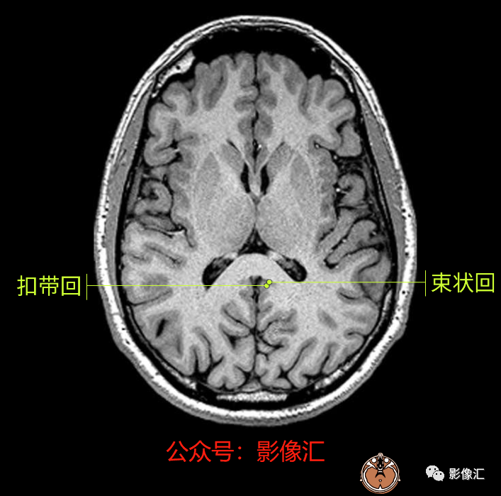影像PPT - 脑边缘叶MR解剖标记-40