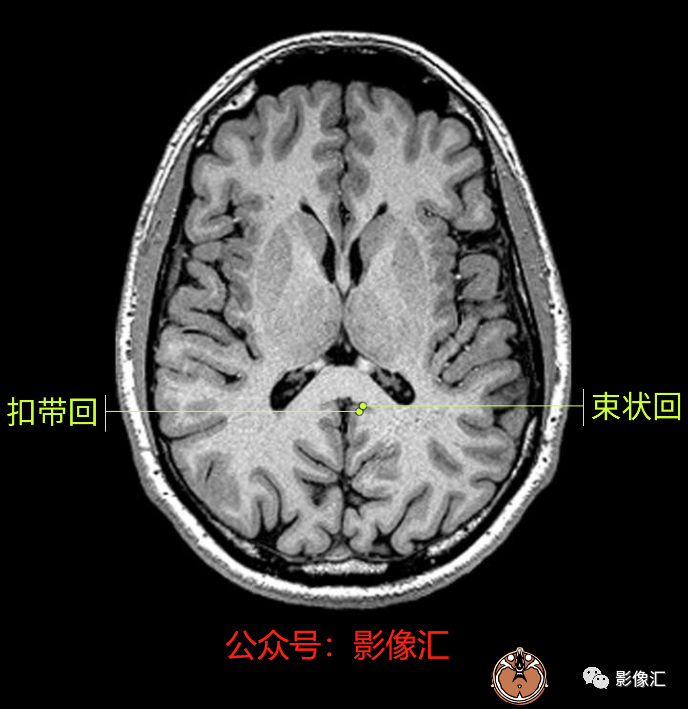 影像PPT - 脑边缘叶MR解剖标记-41