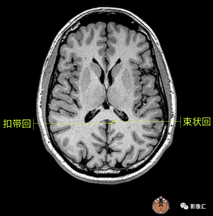 影像PPT - 脑边缘叶MR解剖标记-42