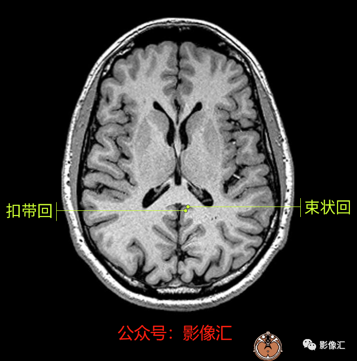 影像PPT - 脑边缘叶MR解剖标记-43