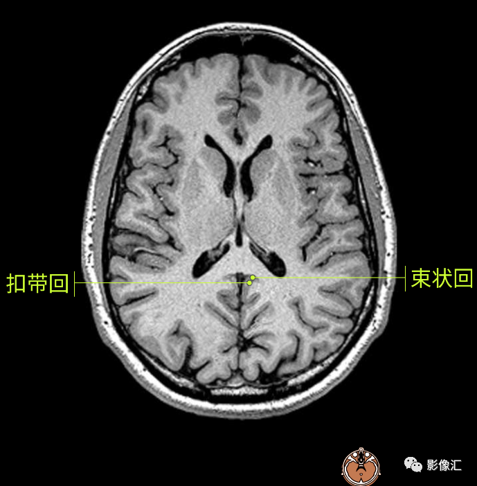影像PPT - 脑边缘叶MR解剖标记-44