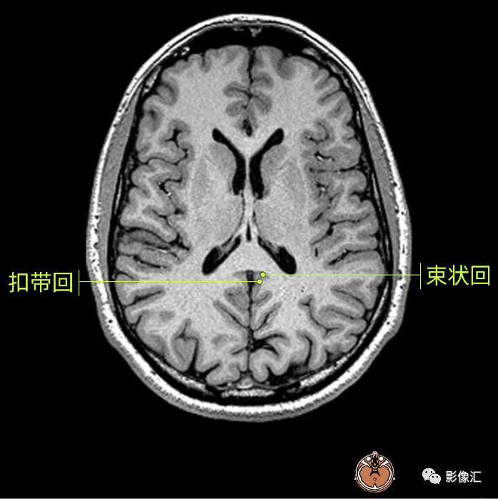 影像PPT - 脑边缘叶MR解剖标记-45