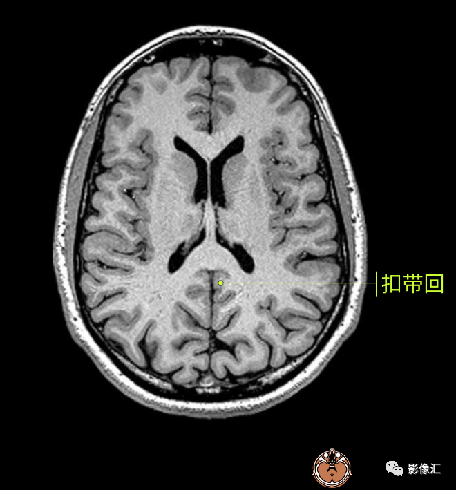 影像PPT - 脑边缘叶MR解剖标记-47