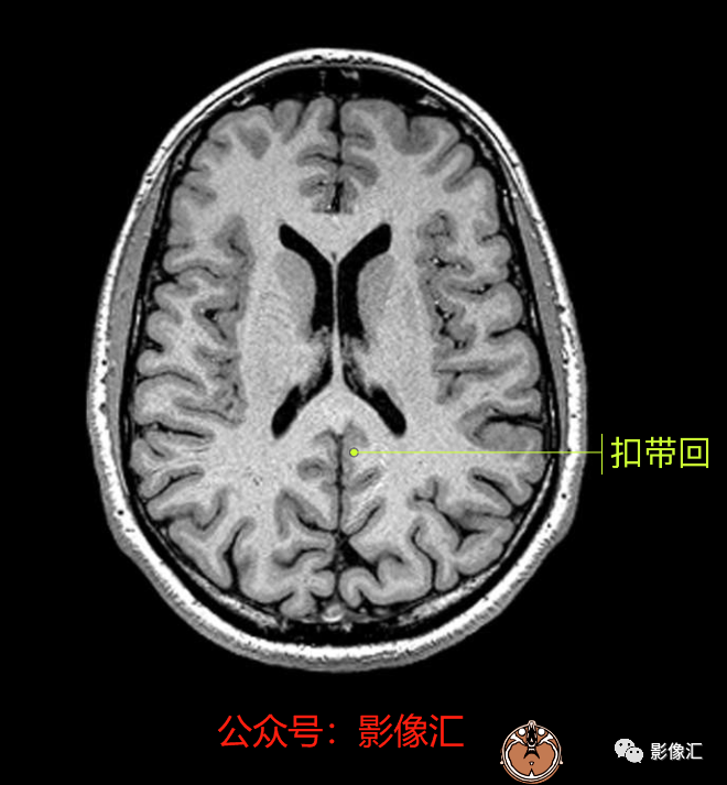 影像PPT - 脑边缘叶MR解剖标记-48