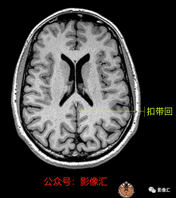 影像PPT - 脑边缘叶MR解剖标记-49