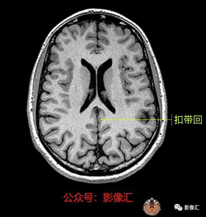 影像PPT - 脑边缘叶MR解剖标记-50
