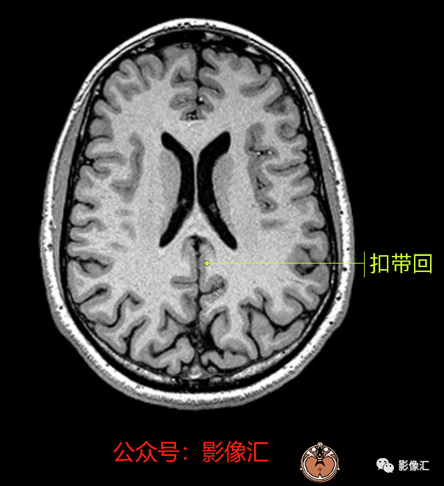 影像PPT - 脑边缘叶MR解剖标记-51