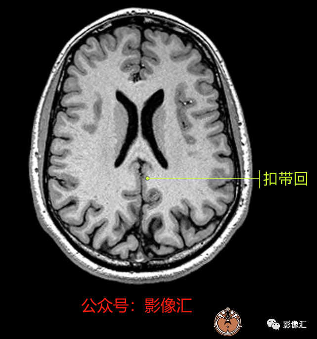影像PPT - 脑边缘叶MR解剖标记-52