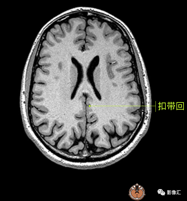 影像PPT - 脑边缘叶MR解剖标记-53