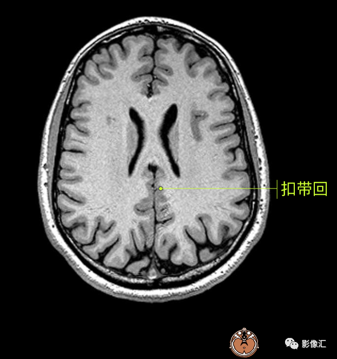 影像PPT - 脑边缘叶MR解剖标记-54