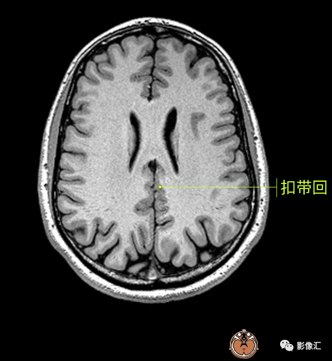 影像PPT - 脑边缘叶MR解剖标记-55