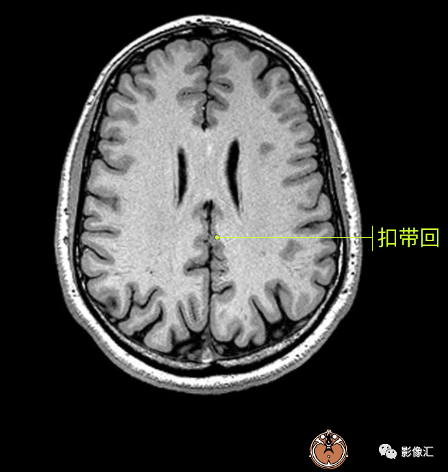 影像PPT - 脑边缘叶MR解剖标记-56