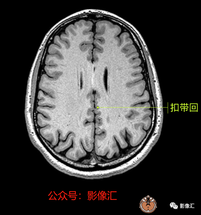 影像PPT - 脑边缘叶MR解剖标记-57
