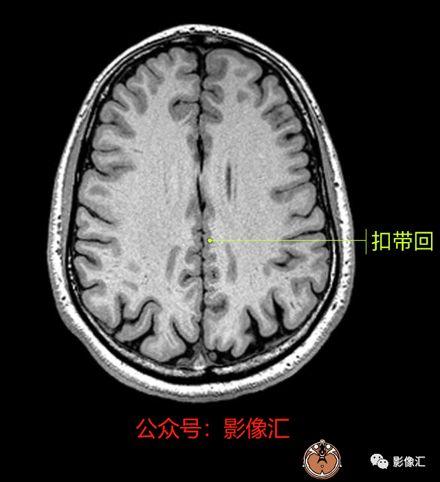 影像PPT - 脑边缘叶MR解剖标记-58