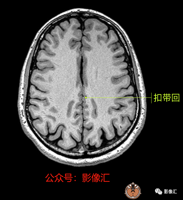 影像PPT - 脑边缘叶MR解剖标记-59