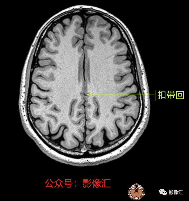 影像PPT - 脑边缘叶MR解剖标记-60