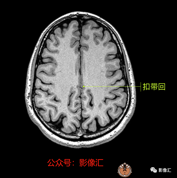 影像PPT - 脑边缘叶MR解剖标记-61
