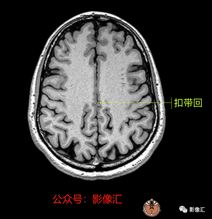 影像PPT - 脑边缘叶MR解剖标记-62