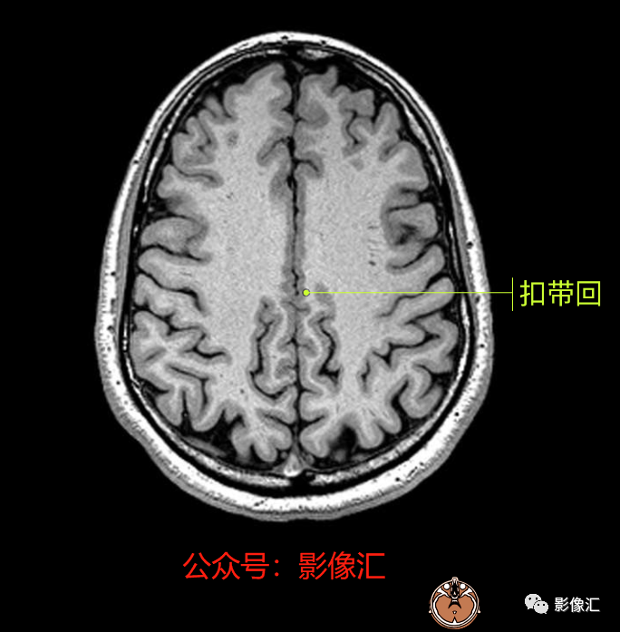 影像PPT - 脑边缘叶MR解剖标记-63