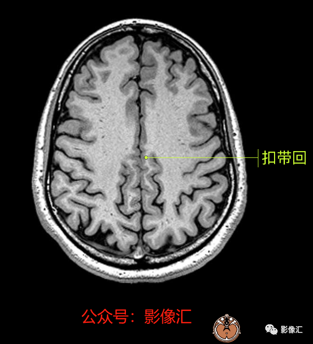 影像PPT - 脑边缘叶MR解剖标记-64