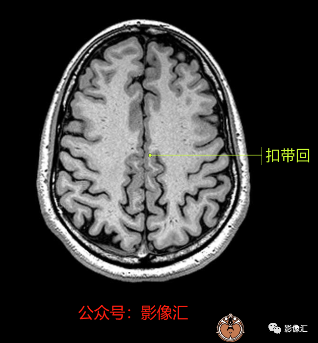 影像PPT - 脑边缘叶MR解剖标记-65