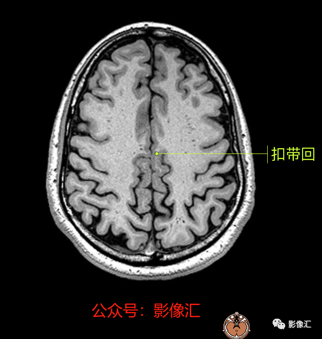 影像PPT - 脑边缘叶MR解剖标记-66