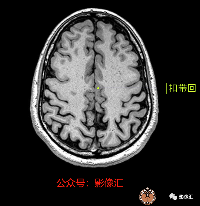 影像PPT - 脑边缘叶MR解剖标记-67