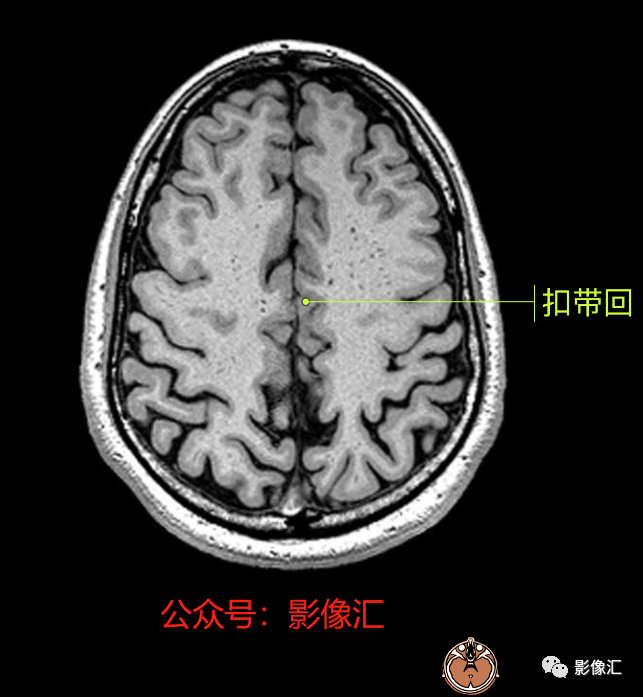 影像PPT - 脑边缘叶MR解剖标记-68
