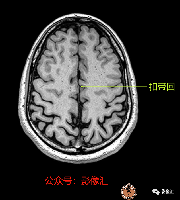影像PPT - 脑边缘叶MR解剖标记-69
