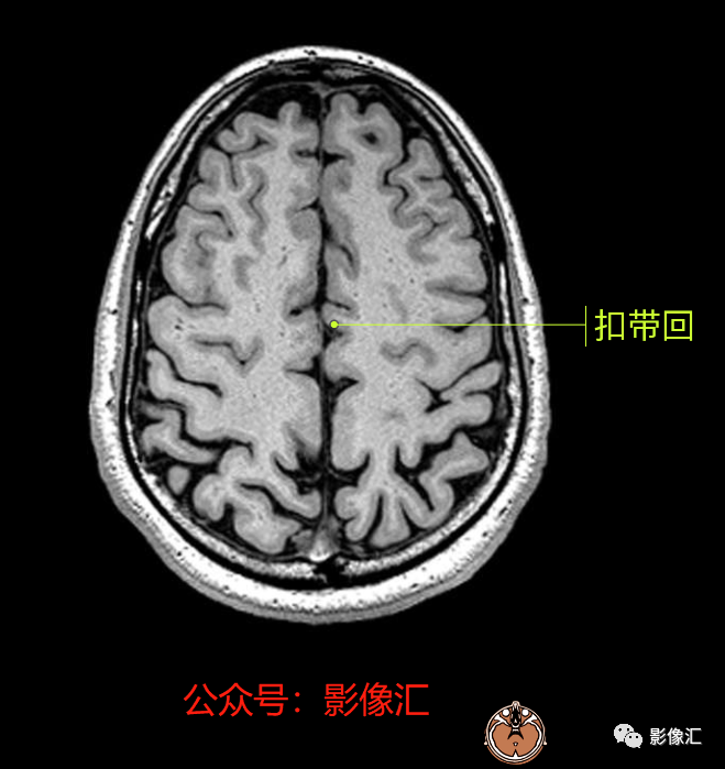 影像PPT - 脑边缘叶MR解剖标记-70