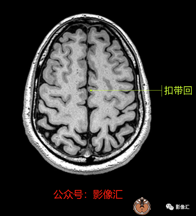 影像PPT - 脑边缘叶MR解剖标记-71