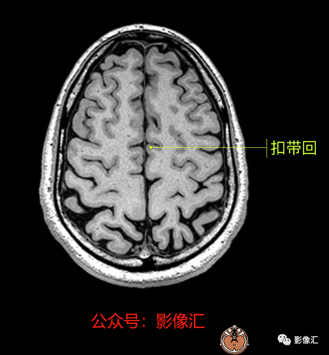 影像PPT - 脑边缘叶MR解剖标记-72
