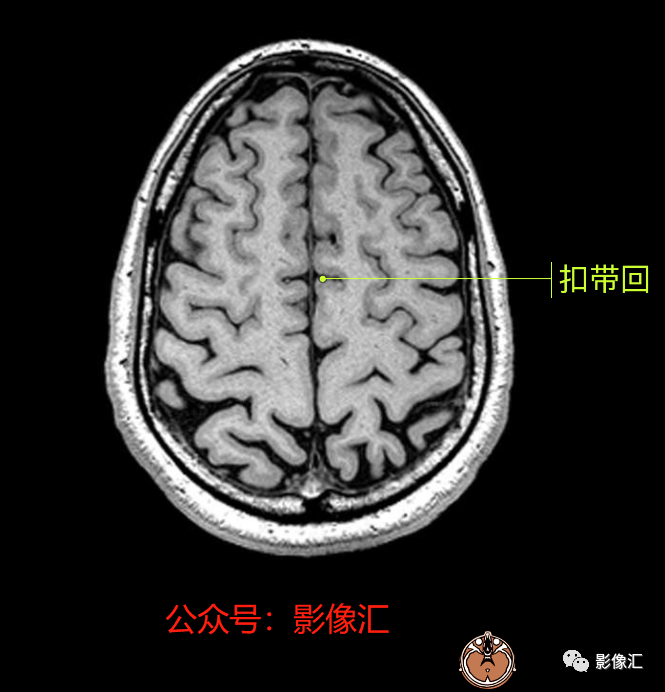 影像PPT - 脑边缘叶MR解剖标记-73