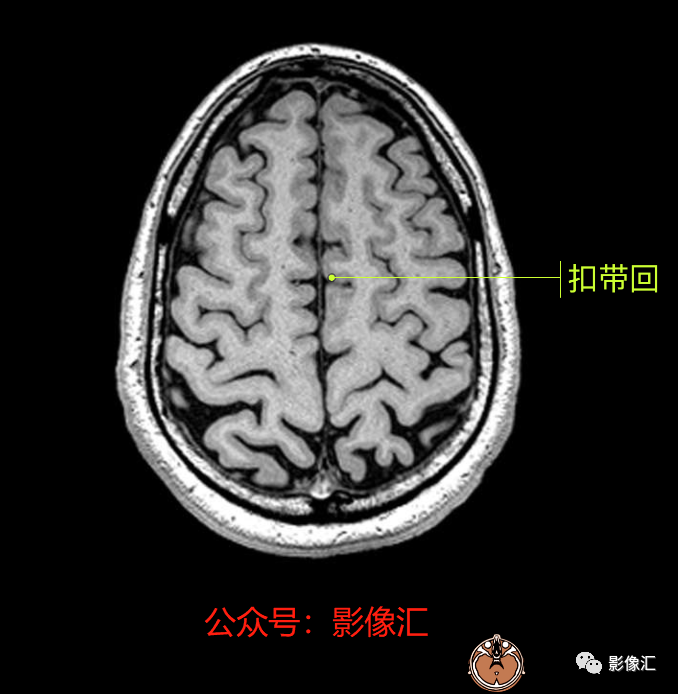 影像PPT - 脑边缘叶MR解剖标记-74