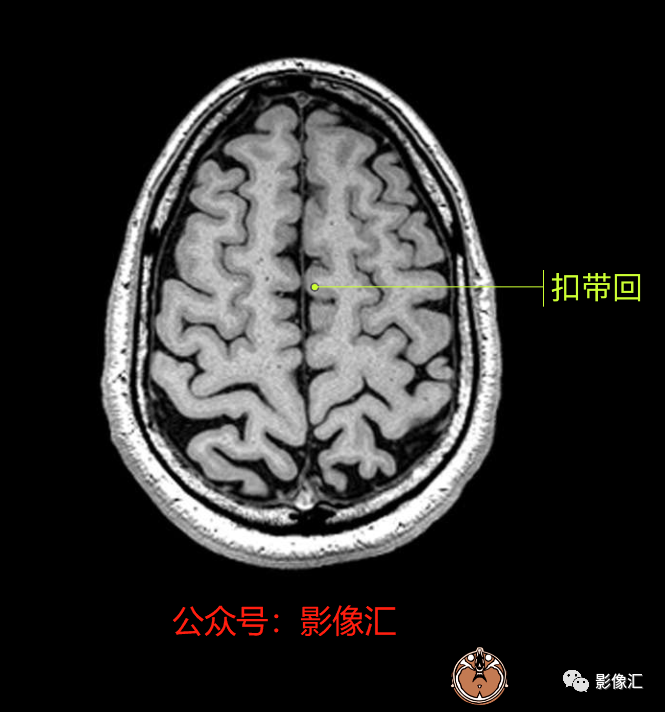 影像PPT - 脑边缘叶MR解剖标记-75