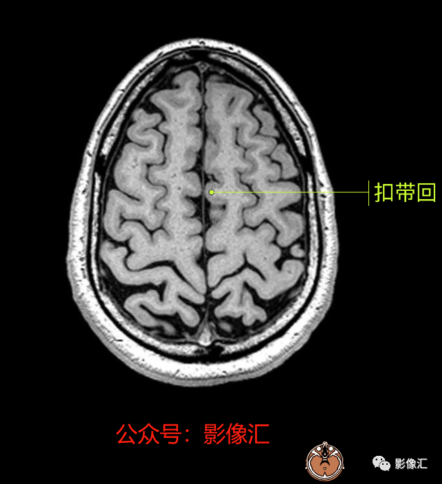 影像PPT - 脑边缘叶MR解剖标记-76