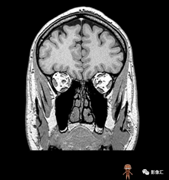 影像PPT - 脑边缘叶MR解剖标记-77