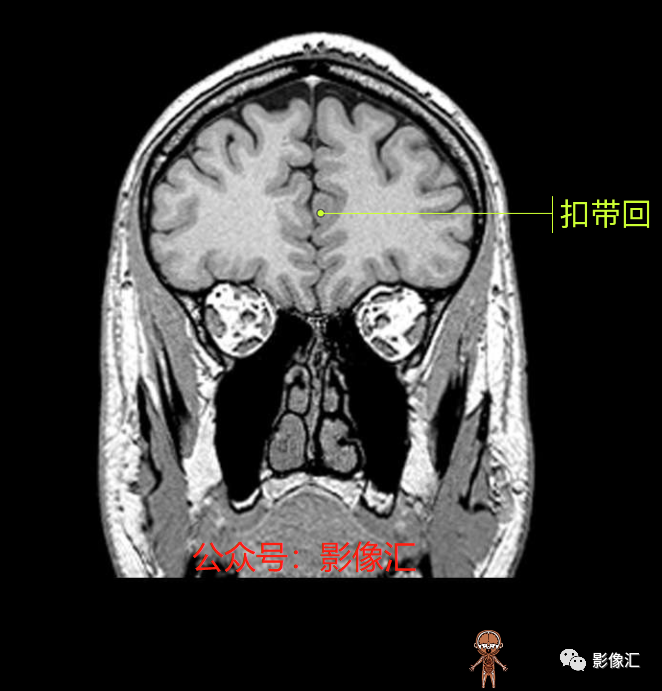 影像PPT - 脑边缘叶MR解剖标记-78