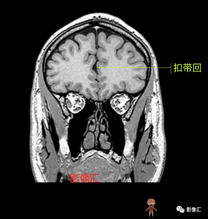 影像PPT - 脑边缘叶MR解剖标记-79
