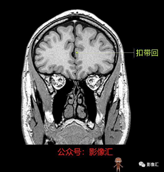 影像PPT - 脑边缘叶MR解剖标记-80