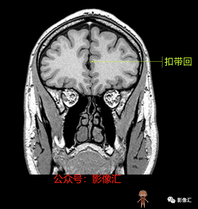 影像PPT - 脑边缘叶MR解剖标记-81