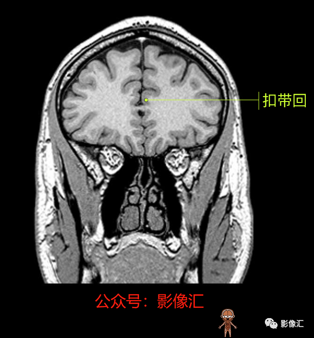 影像PPT - 脑边缘叶MR解剖标记-82
