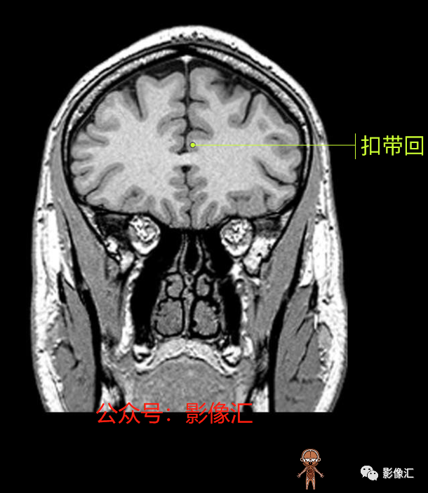 影像PPT - 脑边缘叶MR解剖标记-83