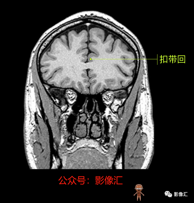 影像PPT - 脑边缘叶MR解剖标记-84