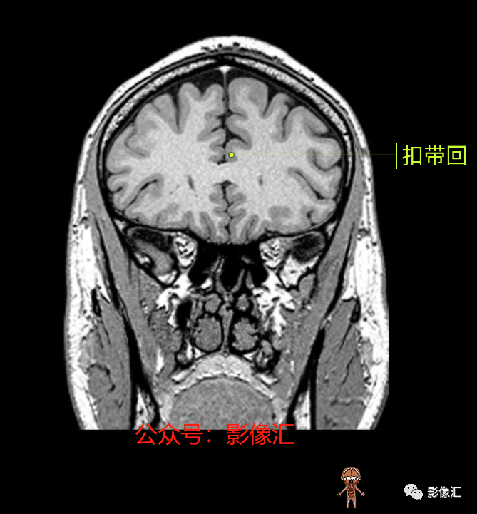 影像PPT - 脑边缘叶MR解剖标记-85
