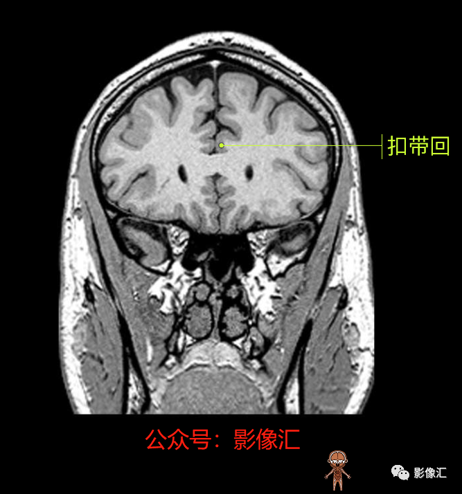 影像PPT - 脑边缘叶MR解剖标记-86